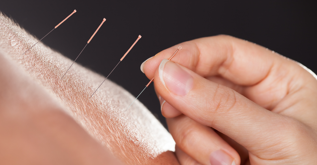 Close-up of acupuncture needles being gently inserted into the skin