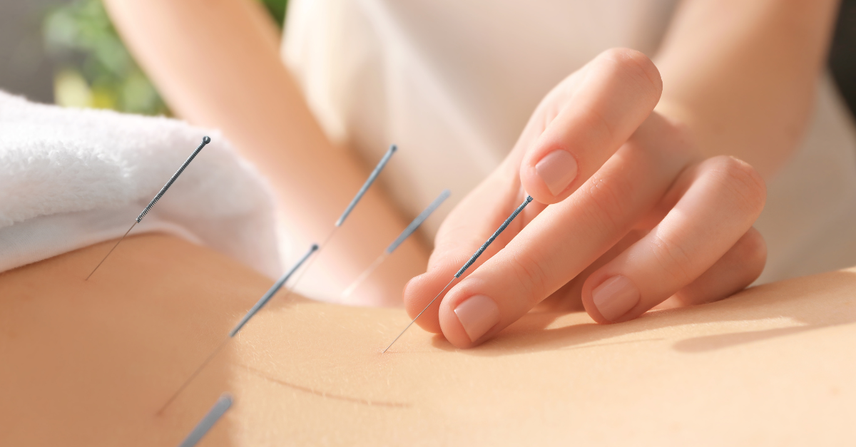 Close-up of acupuncture needles placed on a patient's back